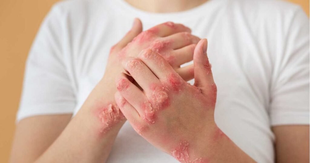 hand fuß mund krankheit